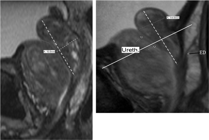 prostate volume mri)