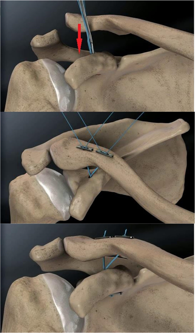 Tegnsætning Sælger snack Surgical treatment of acute Rockwood III acromioclavicular  dislocations—Comparative study between two flip-button techniques |  Scientific Reports
