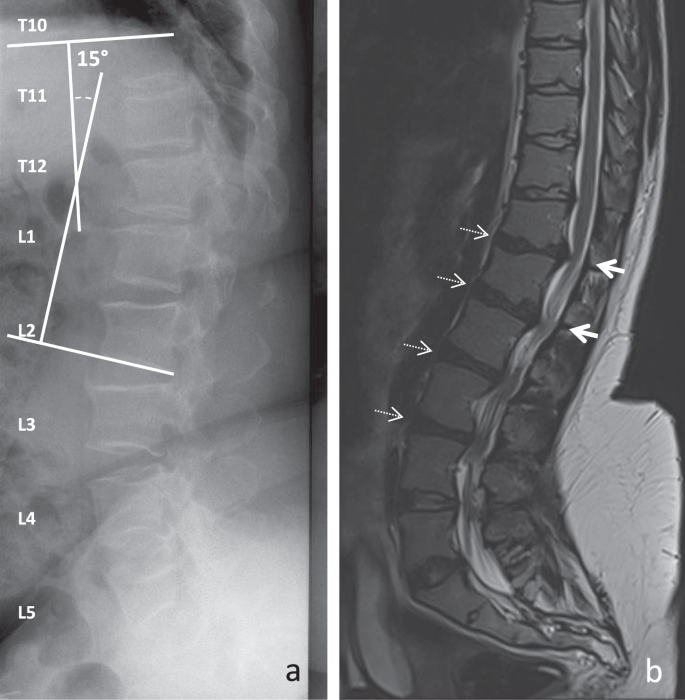 Lumbar Spinal Stenosis And Disc Alterations Affect The Upper Lumbar Spine In Adults With Achondroplasia Scientific Reports