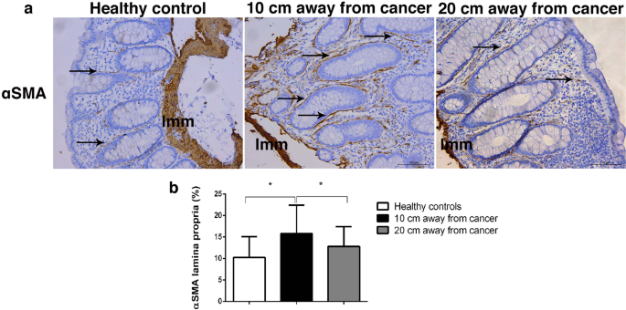 Plague Summit birth Altered organization of collagen fibers in the uninvolved human colon mucosa 10 cm and 20 cm away from the malignant tumor | Scientific Reports Plague Summit birth Altered organization of collagen fibers in the uninvolved human colon mucosa 10 cm and 20 cm away from the malignant tumor | Scientific Reports