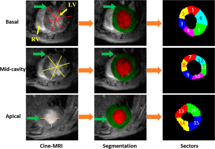 MRI-Derived Myocardial Strain Measures in Normal Subjects - ScienceDirect