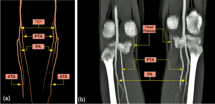 Popliteal Artery Branching Variations: A Study on Multidetector CT  Angiography | Scientific Reports