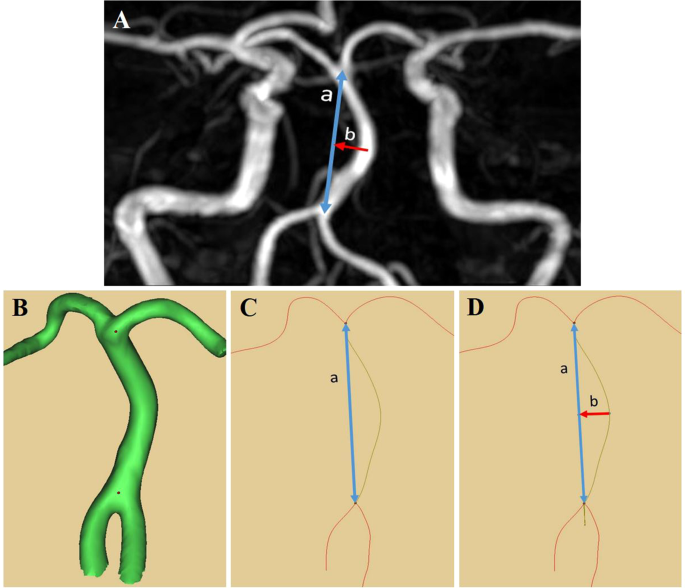 Change in basilar artery length and bending according to aging and  vertebral artery dominance: A longitudinal study | Scientific Reports