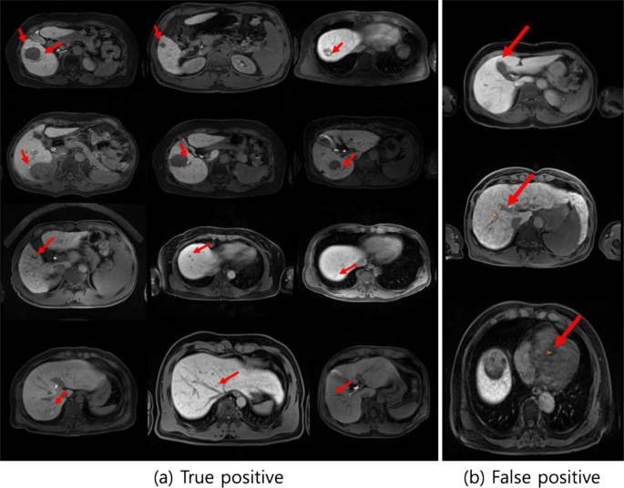 Detection Of Hepatocellular Carcinoma In Contrast Enhanced Magnetic Resonance Imaging Using Deep Learning Classifier A Multi Center Retrospective Study Scientific Reports