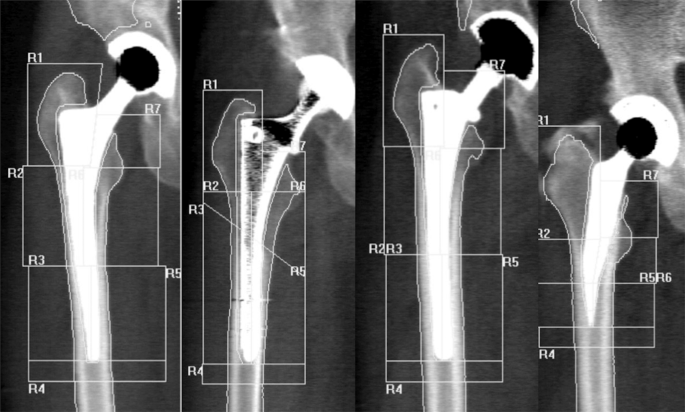 Long Term Follow Up Of Bone Remodelling After Cementless Hip Arthroplasty Using Different Stems Scientific Reports