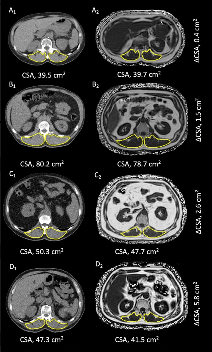 Body composition analysis using CT and MRI: intra-individual intermodal  comparison of muscle mass and myosteatosis | Scientific Reports