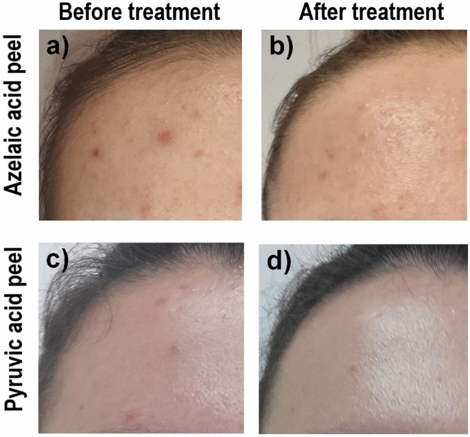 A comparison of the effectiveness of azelaic and pyruvic acid peels in the  treatment of female adult acne: a randomized controlled trial | Scientific  Reports