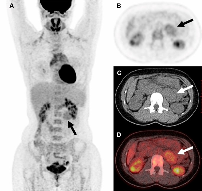 The value of multiparameter 18F-FDG PET/CT imaging in differentiating  retroperitoneal paragangliomas from unicentric Castleman disease |  Scientific Reports