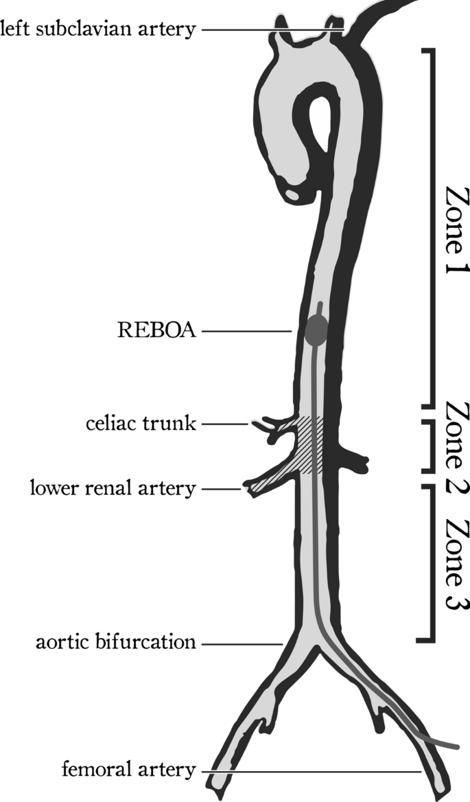 Standardized distances for placement of REBOA in patients with aortic  stenosis | Scientific Reports