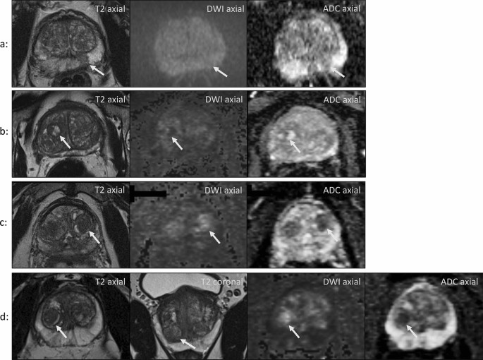 prostatitis mri pi rads