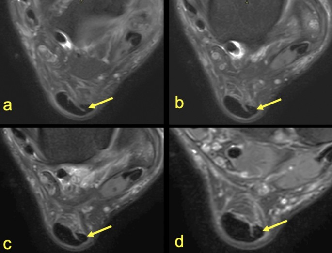 Distribution Of The Subtendons In The Midportion Of The Achilles Tendon Revealed In Vivo On Mri Scientific Reports