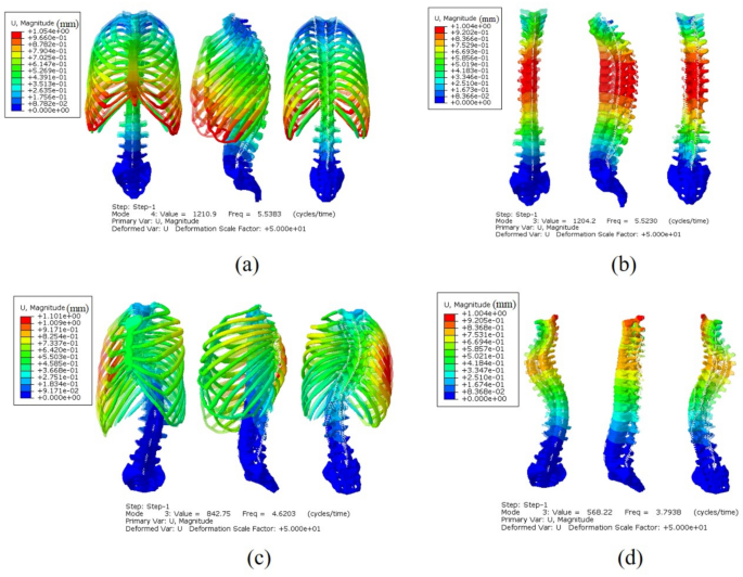 The Influence Of The Rib Cage On The Static And Dynamic Stability Responses Of The Scoliotic Spine Scientific Reports