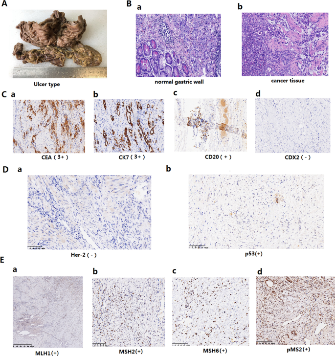 The role of prognostic nutritional index for clinical outcomes of gastric  cancer after total gastrectomy | Scientific Reports