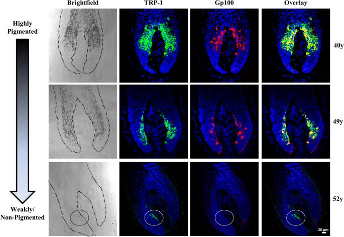 Stress Sensing In The Human Greying Hair Follicle Ataxia Telangiectasia Mutated Atm Depletion In Hair Bulb Melanocytes In Canities Prone Scalp Scientific Reports