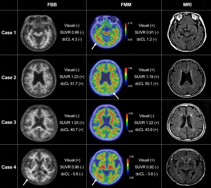 Concordance in detecting amyloid positivity between 18F-florbetaben and  18F-flutemetamol amyloid PET using quantitative and qualitative assessments  | Scientific Reports