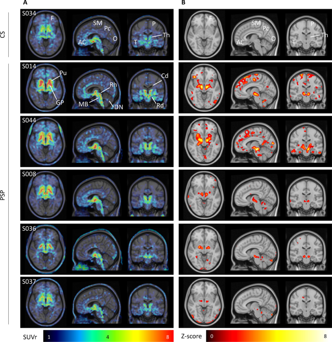 18F-THK5351 PET imaging in patients with progressive supranuclear palsy:  associations with core domains and diagnostic certainty | Scientific Reports