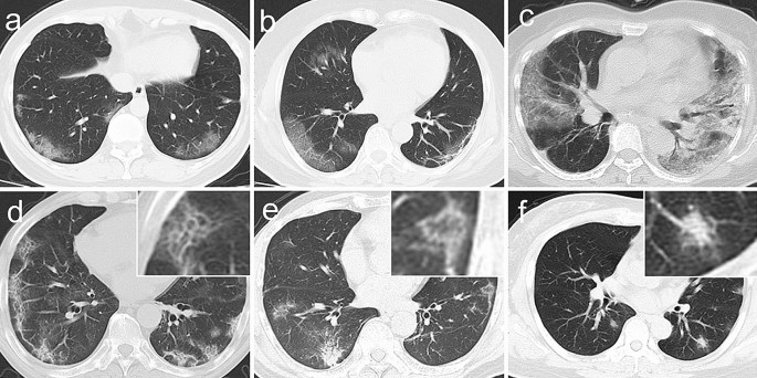 Temporal Lung Changes On Thin Section Ct In Patients With Covid 19 Pneumonia Scientific Reports