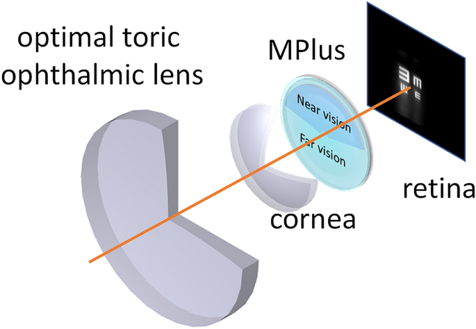 New method to improve the quality of vision in cataractous keratoconus eyes  | Scientific Reports