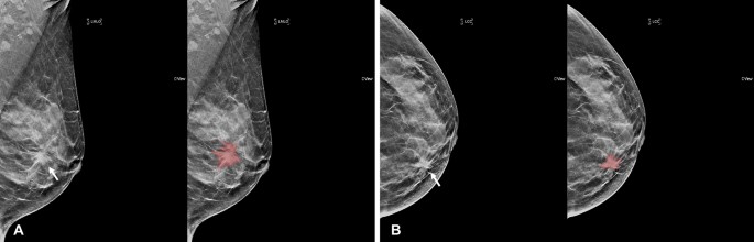 breast cancer digital mammogram