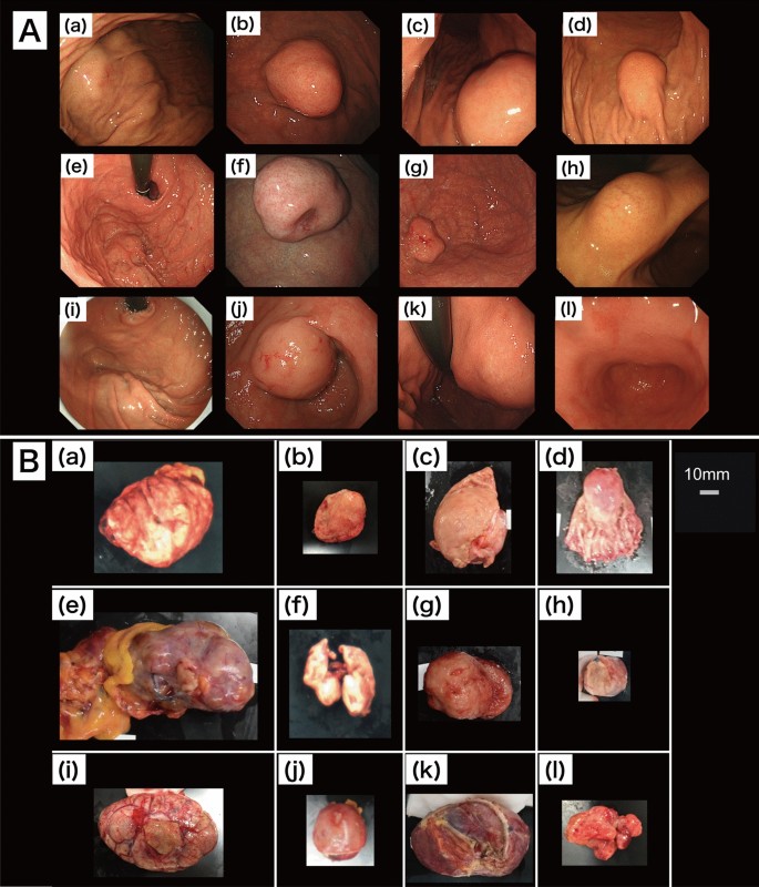 Distinction Of Surgically Resected Gastrointestinal Stromal Tumor By  Near-Infrared Hyperspectral Imaging | Scientific Reports