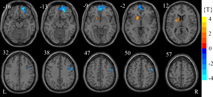 Regional homogeneity abnormalities of resting state brain activities in  children with growth hormone deficiency | Scientific Reports