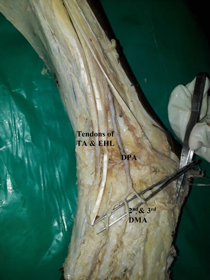 Variations in the origin, course and branching pattern of dorsalis pedis  artery with clinical significance | Scientific Reports