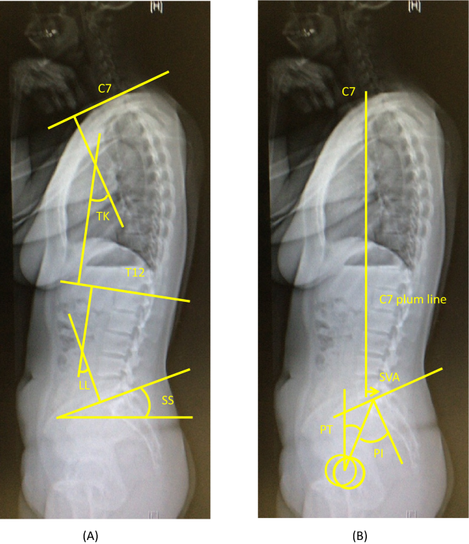 Relationship of sagittal spinal alignment with low back pain and physical  performance in the general population | Scientific Reports