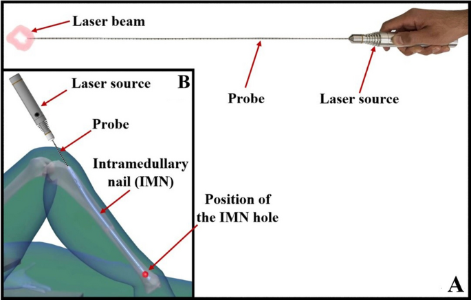 Intramedullary nail holes laser indicator, a non-invasive technique for  interlocking of intramedullary nails | Scientific Reports