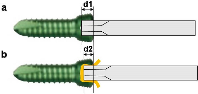 Screw stripping and its prevention in the hexagonal socket of 3.5 
