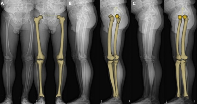 Evaluation Of The Reliability Of Lower Extremity Alignment Measurements Using Eos Imaging System While Standing In An Even Weight Bearing Posture Scientific Reports