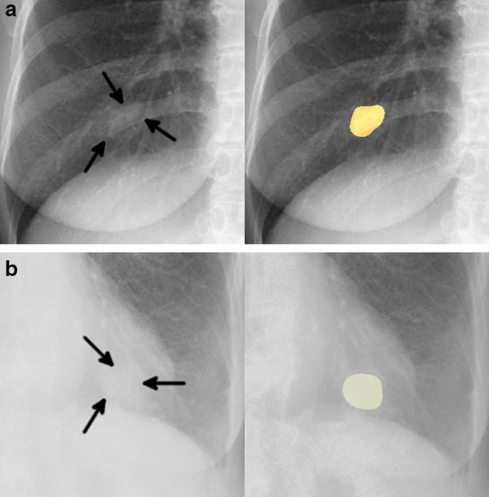 lung cancer thesis statement figure 3