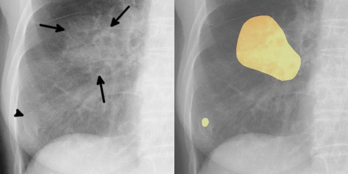 lung cancer thesis statement figure 4