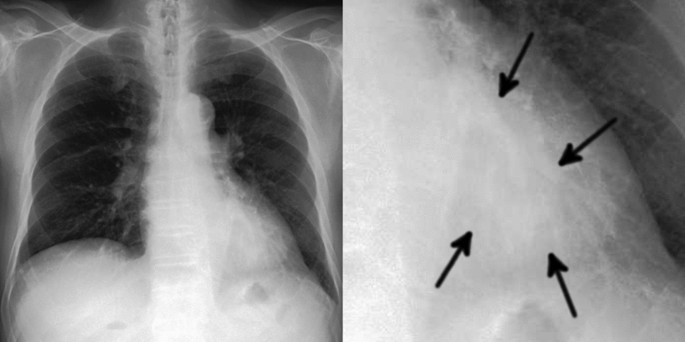 lung cancer thesis statement figure 5