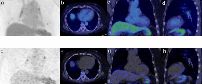 Value of Patlak Ki images from 18F-FDG-PET/CT for evaluation of the  relationships between disease activity and clinical events in cardiac  sarcoidosis | Scientific Reports