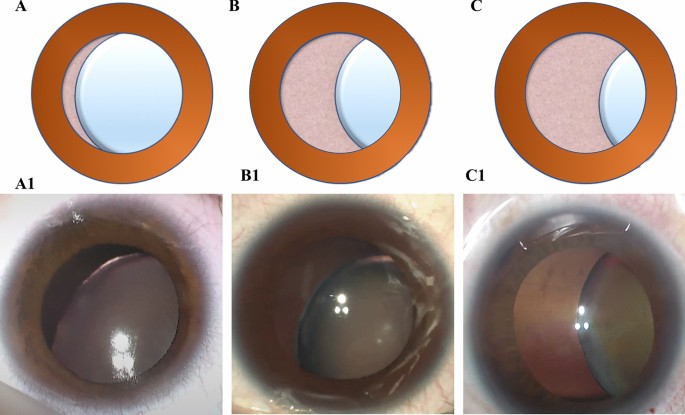 Visual outcomes of lens subluxation surgery with Cionni modified capsular  tension rings in Marfan syndrome | Scientific Reports