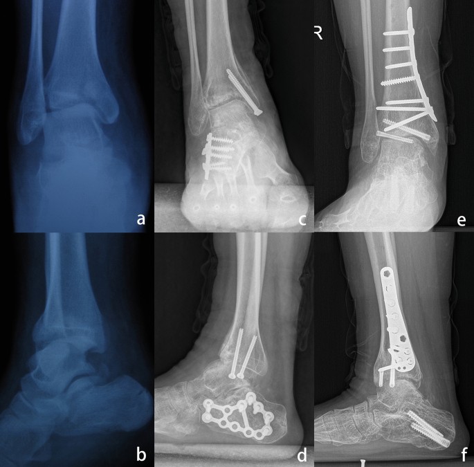 tibial plafond