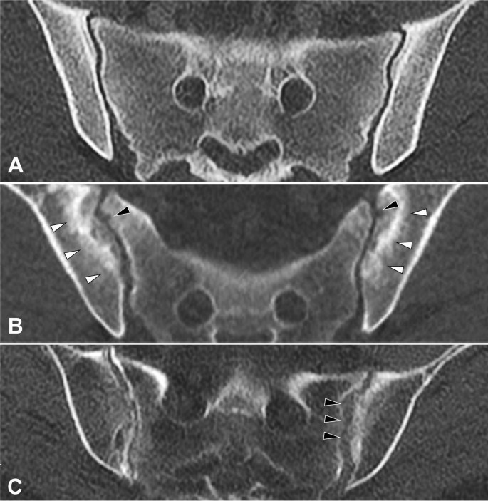 Asymptomatic secondary hyperparathyroidism can mimic sacroiliitis on  computed tomography | Scientific Reports