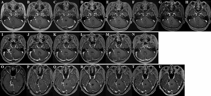 The Behavior Of Residual Tumors Following Incomplete Surgical Resection For Vestibular Schwannomas Scientific Reports