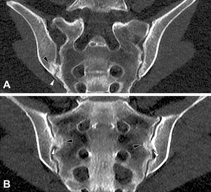 Annoncør Zoologisk have fersken Impact of age, sex, and joint form on degenerative lesions of the  sacroiliac joints on CT in the normal population | Scientific Reports