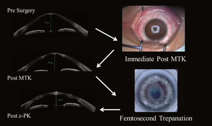 Comparison of penetrating keratoplasty outcomes with or without microwave  thermokeratoplasty | Scientific Reports