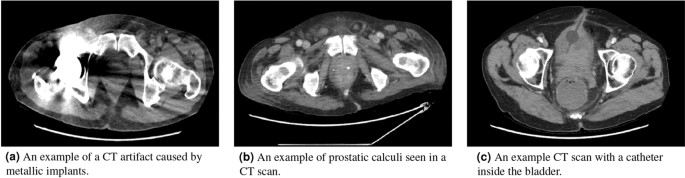 prostatitis a ct- n akut prosztatitis a rendszerekben