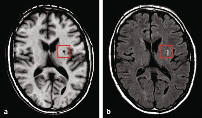An anomaly detection approach to identify chronic brain infarcts on MRI |  Scientific Reports