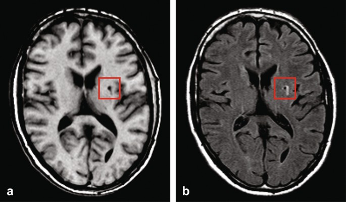 normal brain mri