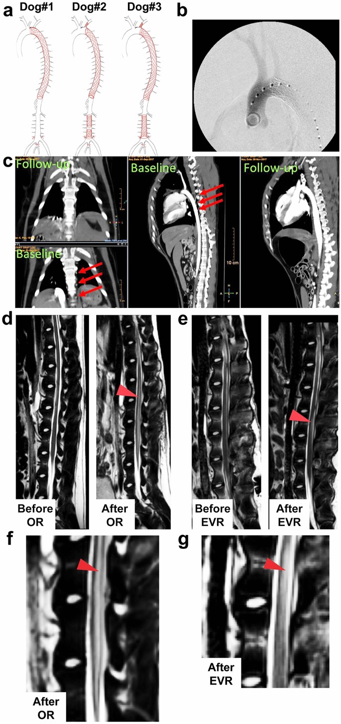 Endovascular repair and open repair surgery of thoraco-abdominal aortic  aneurysms cause drastically different types of spinal cord injury |  Scientific Reports