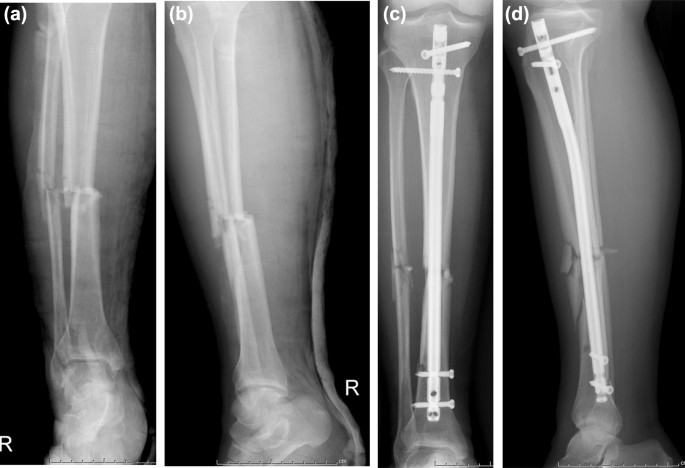 Application of the multiplanar fracture redactor in the treatment of tibial shaft fractures with intramedullary nails | Scientific Reports Application of the multiplanar fracture redactor in the treatment of tibial shaft fractures with intramedullary nails | Scientific Reports