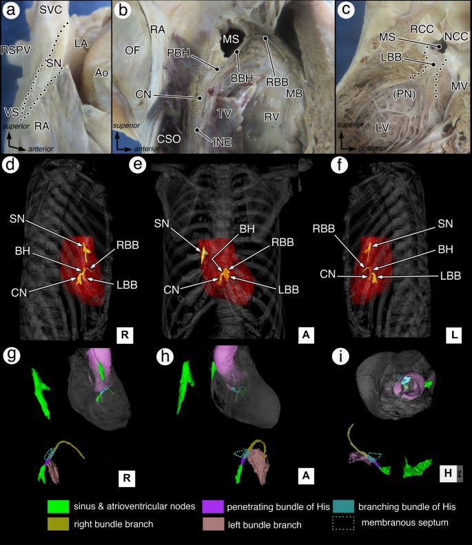 First in situ 3D visualization of the human cardiac conduction system and  its transformation associated with heart contour and inclination |  Scientific Reports