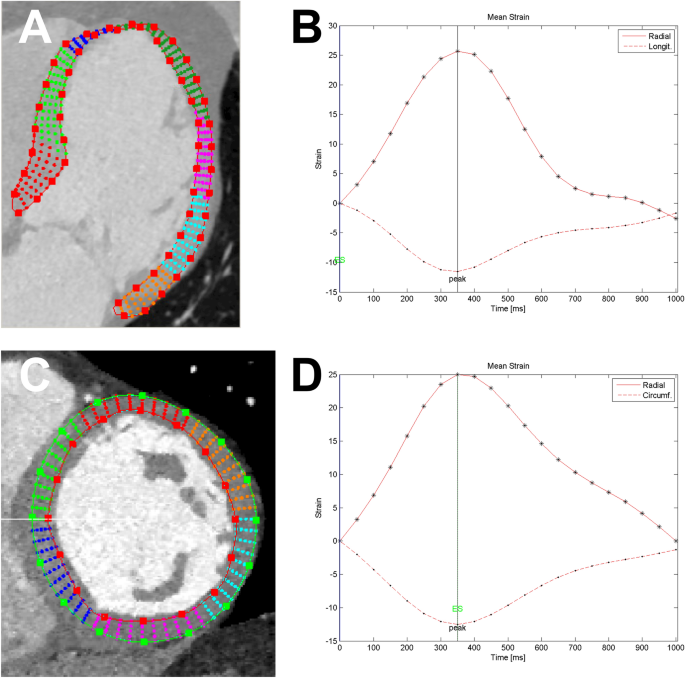 A method for direct estimation of left ventricular global longitudinal  strain rate from echocardiograms