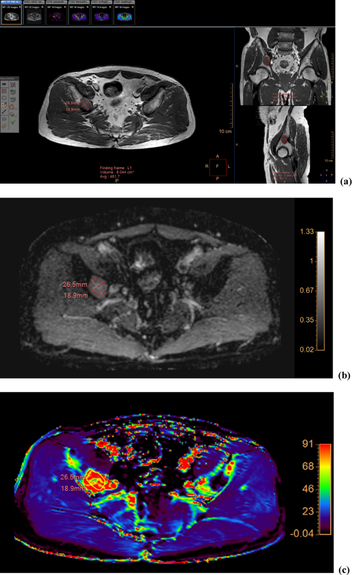 Diffusion-weighted and dynamic contrast-enhanced magnetic resonance imaging  after radiation therapy for bone metastases in patients with hepatocellular  carcinoma | Scientific Reports