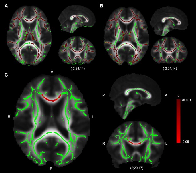 Reduced Frontal White Matter Microstructure In Healthy Older Adults With Low Tactile Recognition Performance Scientific Reports