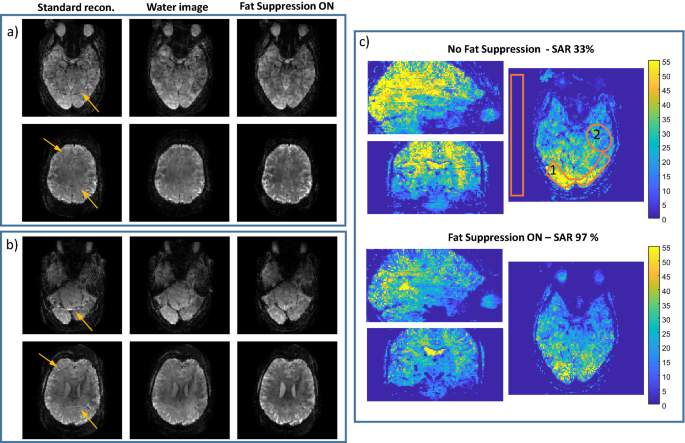 Reducing Sar In 7t Brain Fmri By Circumventing Fat Suppression While Removing The Lipid Signal Through A Parallel Acquisition Approach Scientific Reports